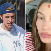 Hailey Bieber y Justin suelen usar los parches para el acné