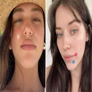 Parches anti acné: la tendencia que crece cada vez más en las redes sociales 
