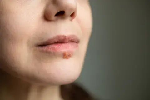 Herpes: la mitad de la población tiene alguno de estos virus, que pueden afectar la piel y las zonas genitales. Herpes: la mitad de la población tiene alguno de estos virus, que pueden afectar la piel y las zonas genitales.