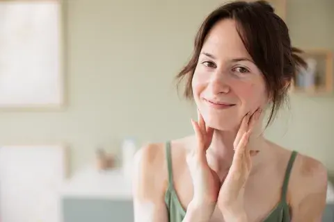 rosacea rosacea