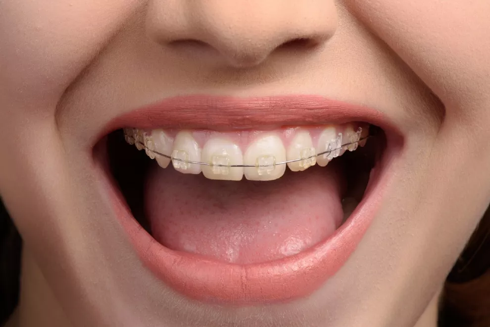 Cuáles son los tratamientos de ortodoncia que existen.