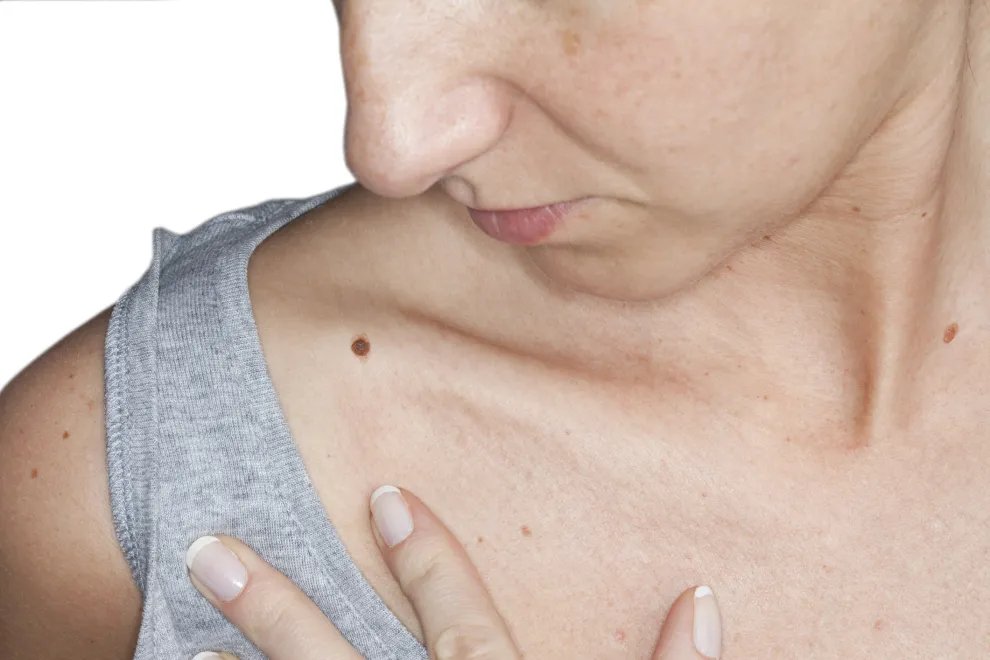 Cáncer de piel: cómo prevenir el melanoma.