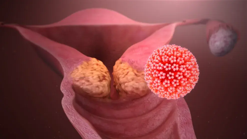 El principal causante de este tipo de cáncer es el Virus del Papiloma Humano.