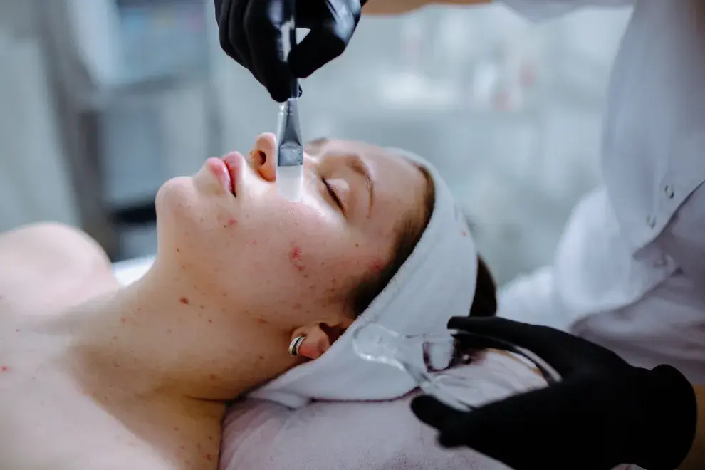 Uno de los mitos más frecuentes es pensar que el acné en la adultez se relaciona con la higiene o con determinados cosméticos.