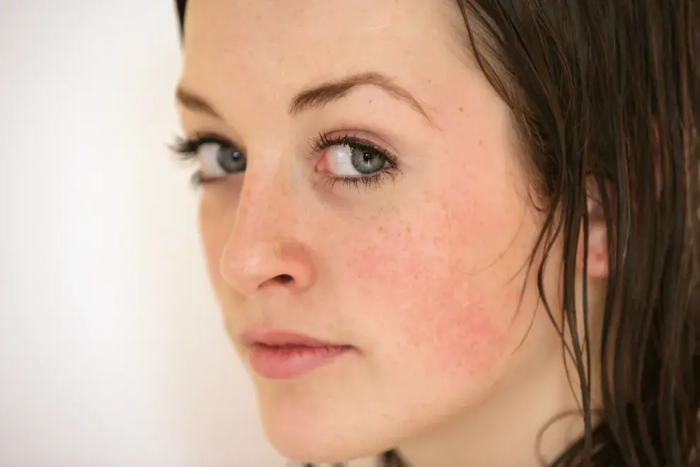 Rosácea en invierno: por qué empeora y cómo cuidar la piel cuando bajan las temperaturas, según un experto