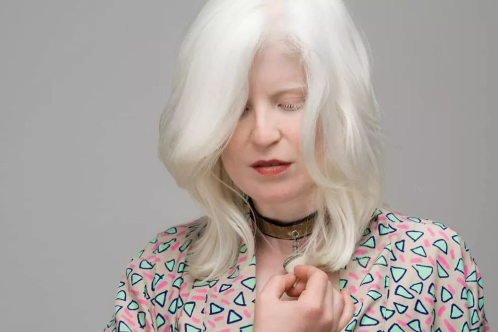 Como otras personas con albinismo, Blanca Nieves Villaba además tiene nistagmus y fotofobia. Foto gentileza