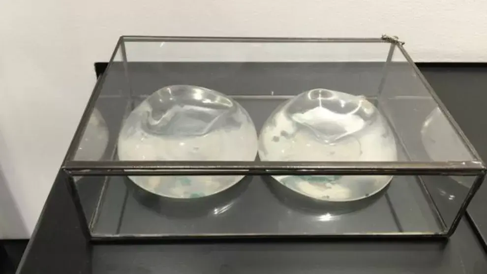 Una mujer donó los implantes de silicona que se puso años atrás a petición de su pareja
