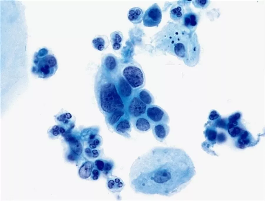 Células escamosas con lesión de alto grado por HPV.