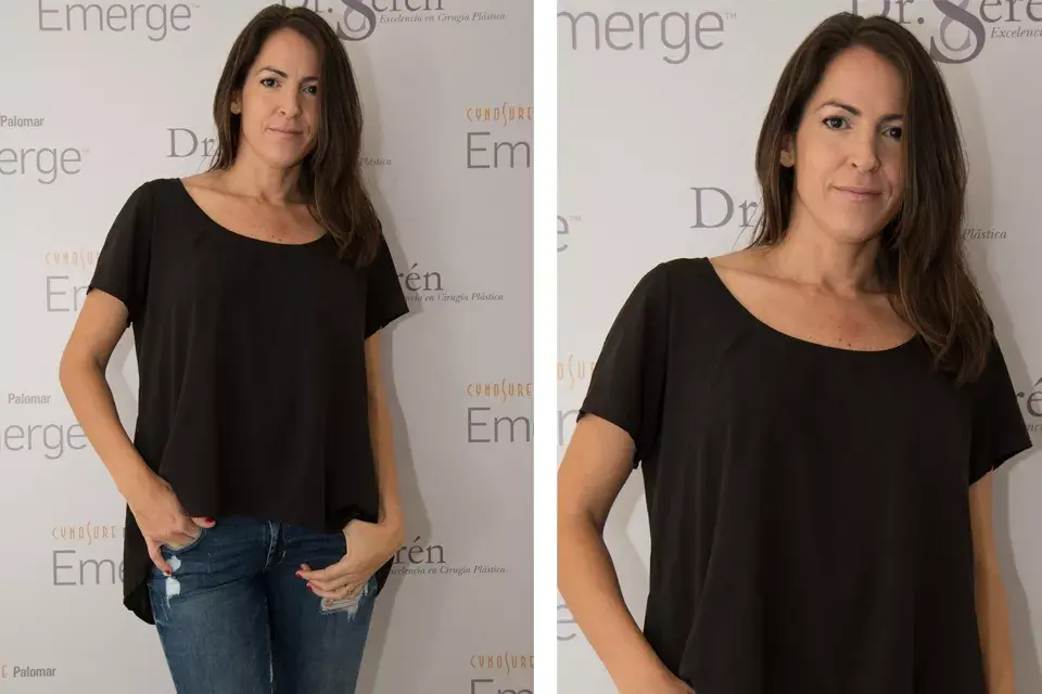 Agustina Lecouna se asesoró con el Dr. Seren en la ultima tecnica de rejuvenecimiento