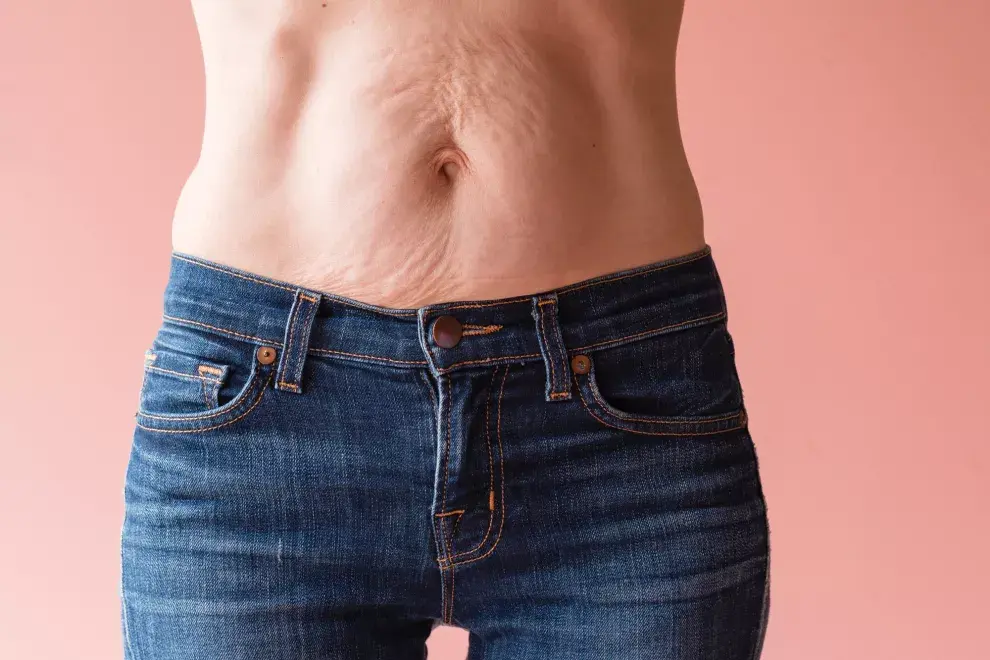 Para qué sirve una abdominoplastia - Dr Fernandez Blanco