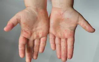 Viruela del mono: aumentan los casos