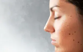 Día Mundial de los Lunares: esto es lo que tenés que observar de tus lunares para detectar lesiones sospechosas Cómo detectar un melanoma.