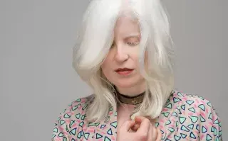 De no creer: Blanca Nieves es albina, sufrió mucho bullying en el colegio y hoy lucha por crear conciencia Como otras personas con albinismo, Blanca Nieves Villaba además tiene nistagmus y fotofobia. Foto gentileza