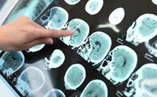 La esclerosis múltiple es una enfermedad del sistema nervioso central que, hasta el momento, no tiene cura