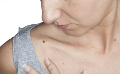 Cómo prevenir el melanoma, una de las formas más mortales de cáncer de piel