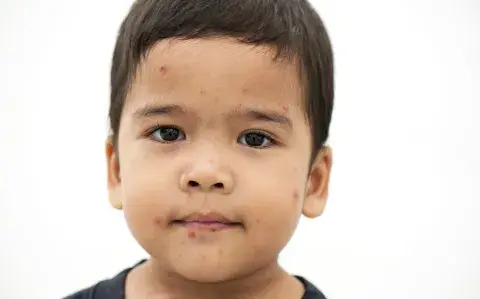 Sarampión: alerta mundial por un fuerte aumento de casos