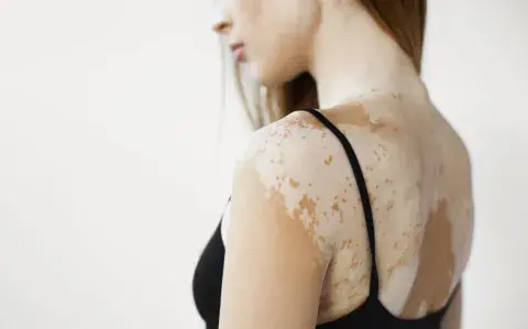 Qué es el Vitiligo y por qué sale: la mirada de una experta Qué es el Vitiligo y por qué sale: la mirada de una experta