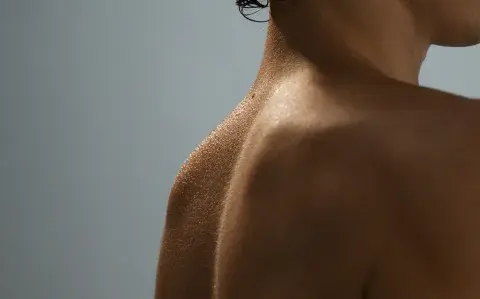 Acné en verano: por qué el sol puede empeorarlo y cómo tratarlo, según una experta