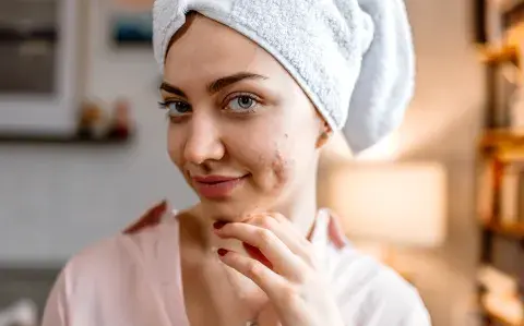 Acné después de los 25: por qué aparece y cuándo consultar