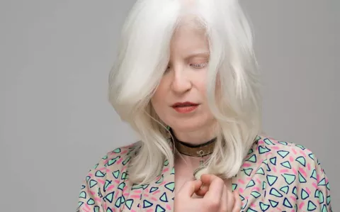 Es albina, sufrió bullying en el colegio y hoy lucha por crear conciencia