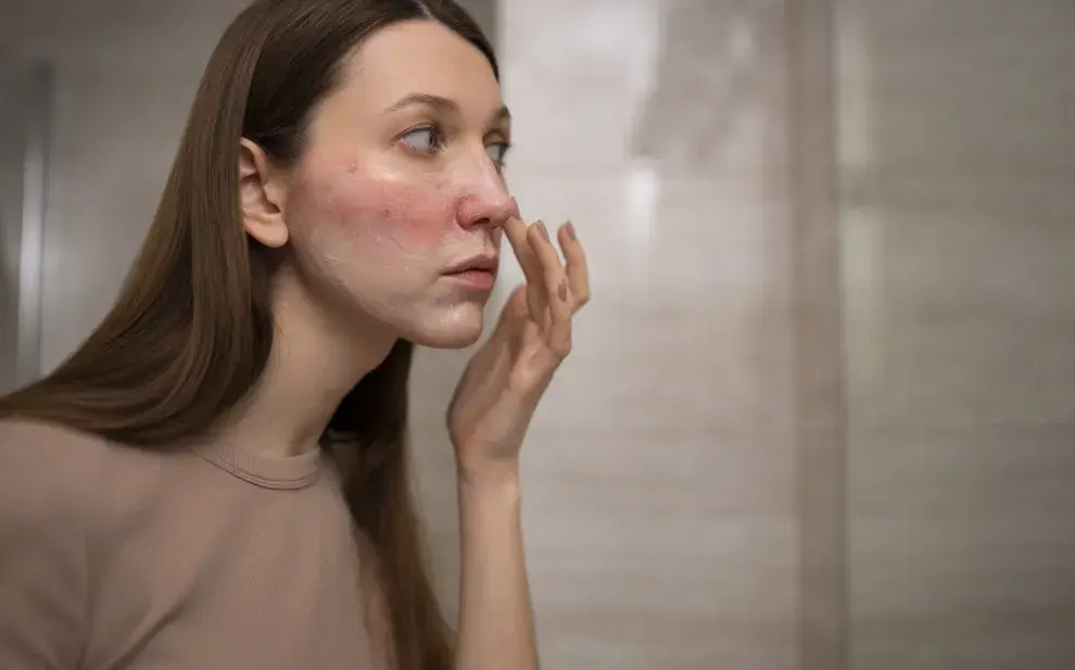 Una mujer con rosacea