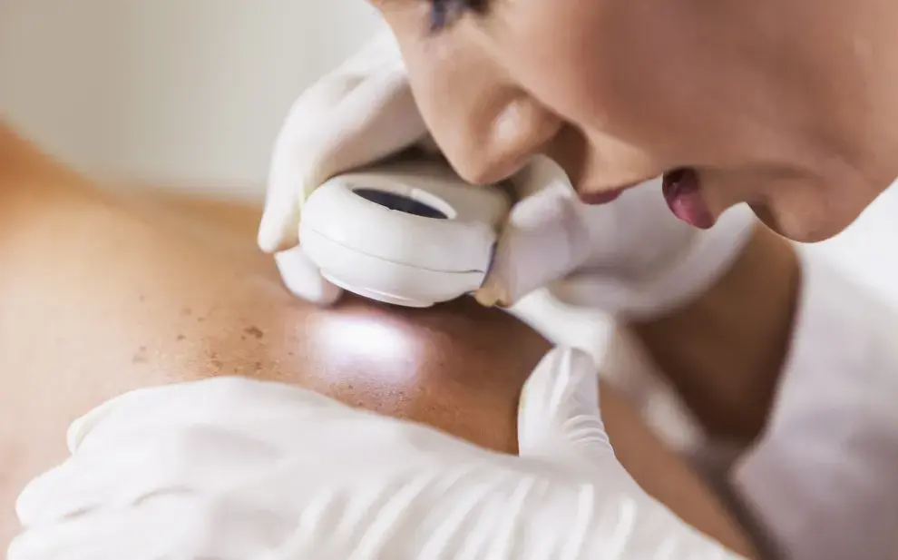 revisión de los lunares para prevenir cáncer de piel