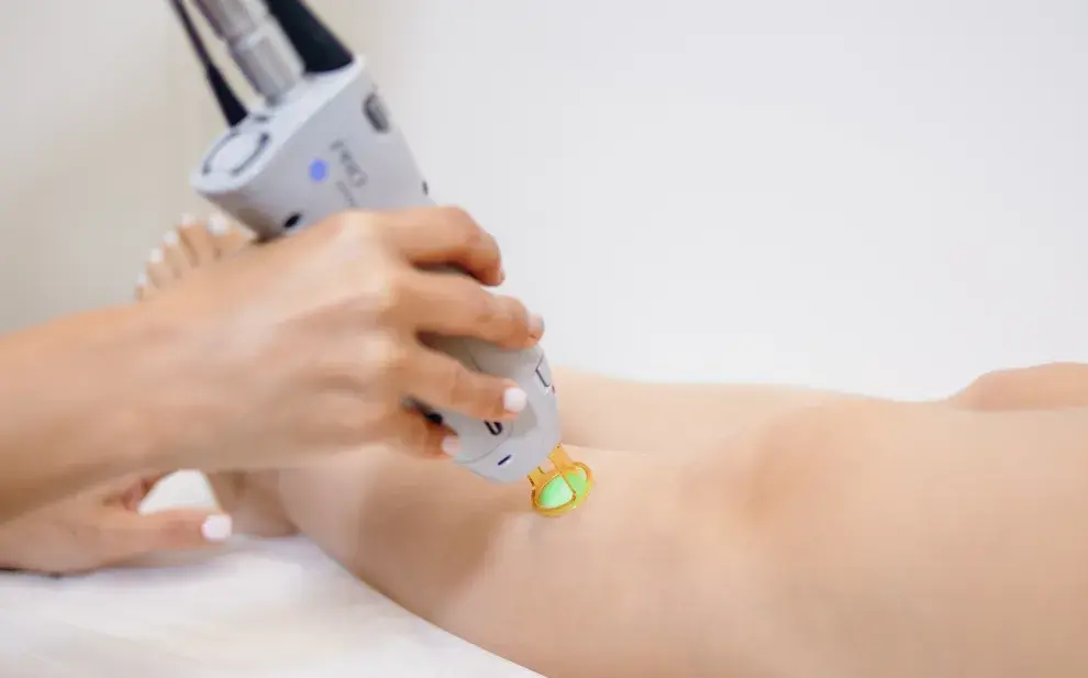 Depilación definitiva en verano