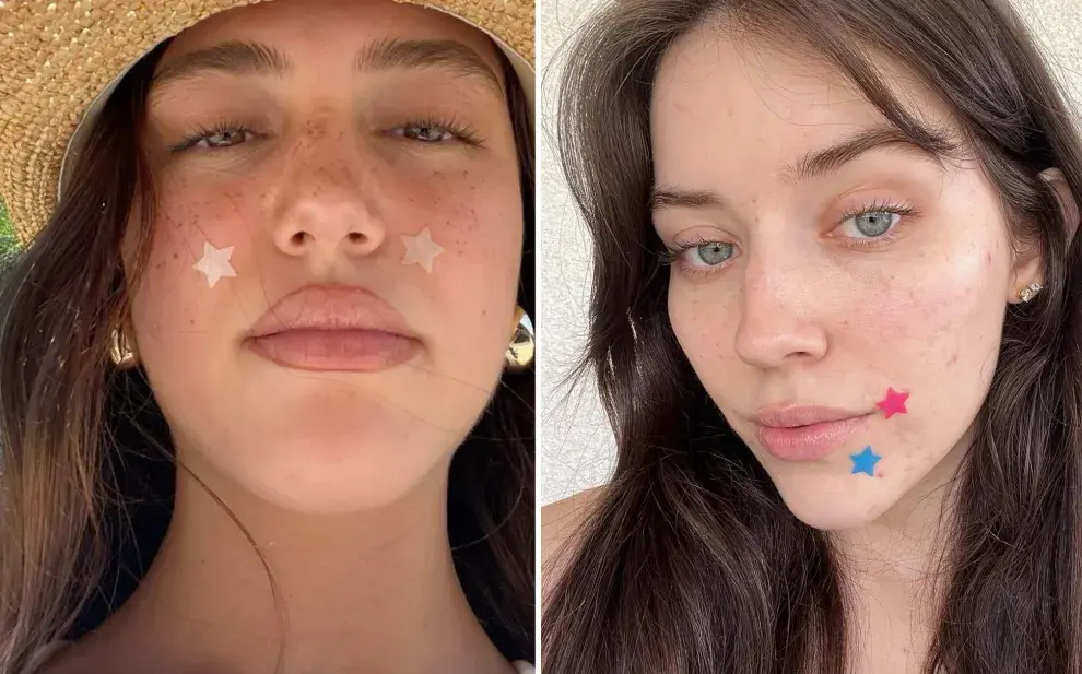 Parches anti acné: la tendencia que crece cada vez más en las redes sociales 