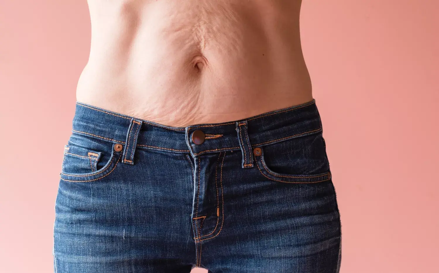 Diástasis: la mayoría la tiene post embarazo. Lo que hay que saber para tratarla